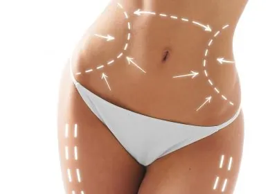 Buik en heupen met behandellijnen voor after lipo massage