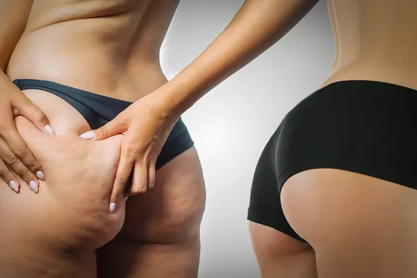 Cellulitis op de billen voor een anti-cellulite behandeling