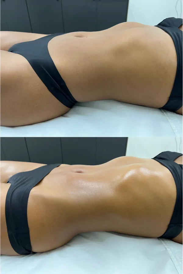 Voor en na een Braziliaanse lymfedrainage: boven een opgezette buik, onder een zichtbaar plattere en strakkere buik