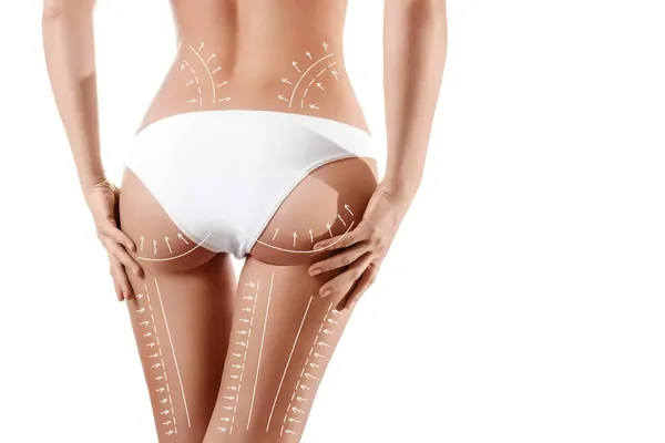 Behandellijnen op billen en benen voor pre- en postoperatieve massage